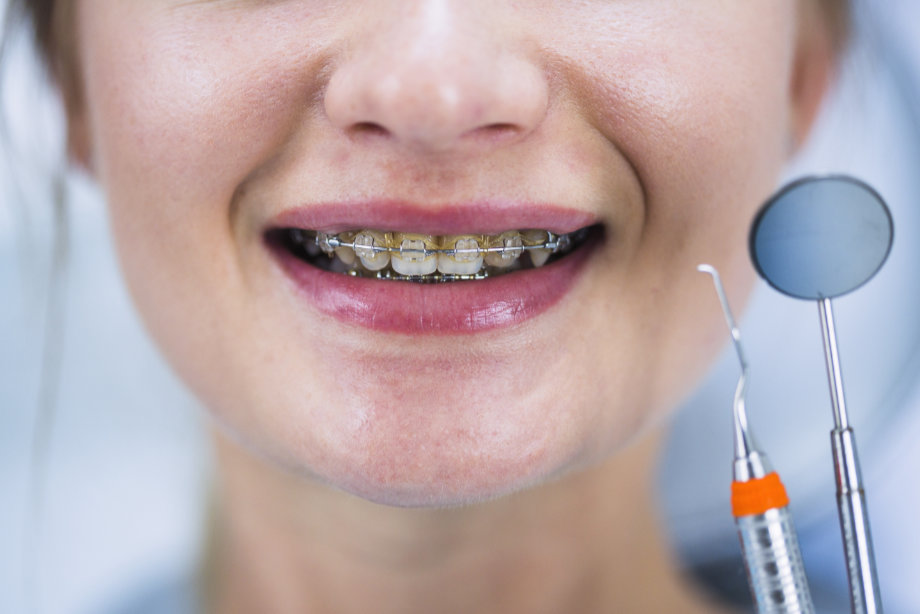 ¿Qué es el sarro dental y cómo podemos prevenirlo?