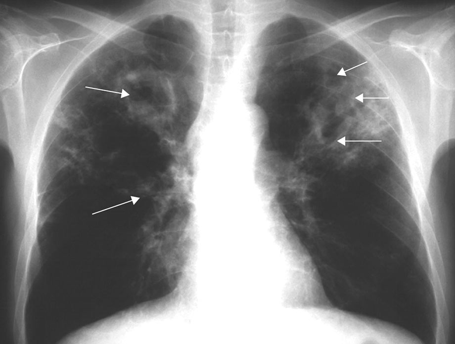 ¿Qué es la tuberculosis ocupacional? ¿Mi trabajo me expone a esta enfermedad? - Medical Assistant